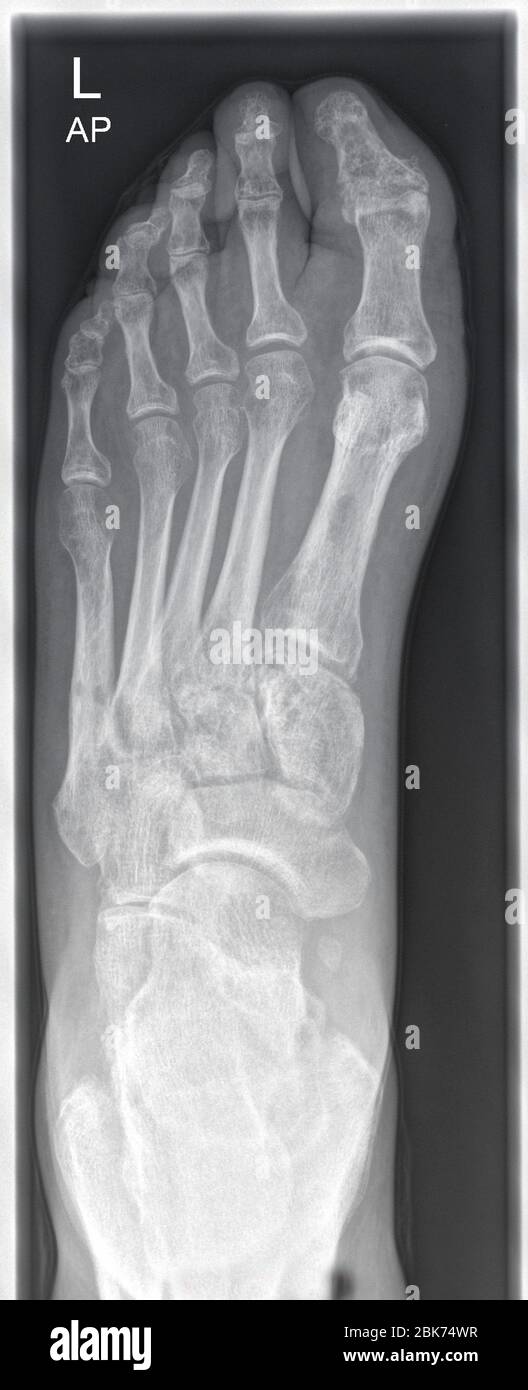 Röntgenaufnahme, Röntgenbild eines menschlichen linken Fußes Stockfoto