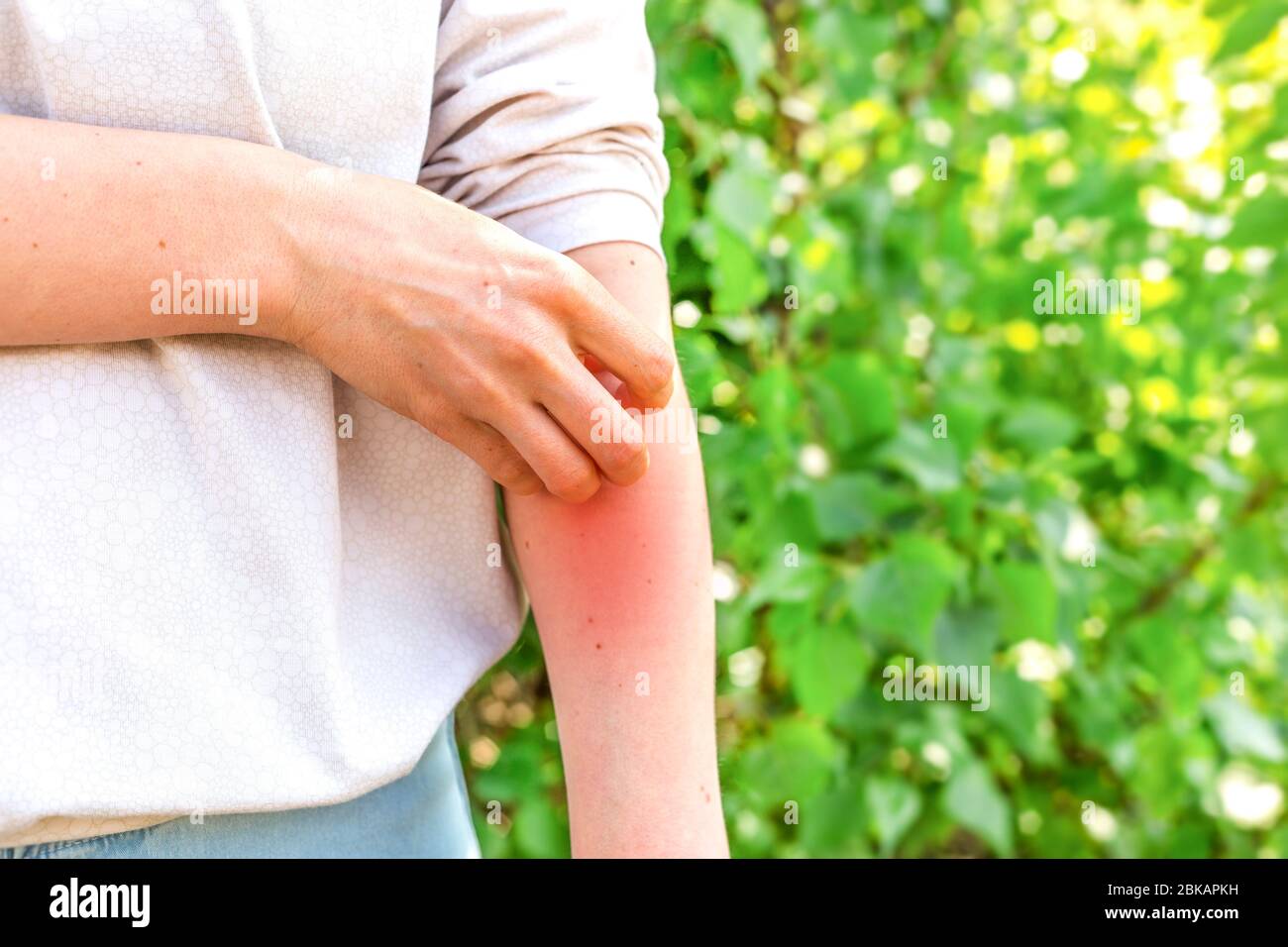Hautallergie. Das Konzept der Dermatitis und Krätze. Eine Frau kratzt sich an den Händen an Mückenstichen. Stockfoto