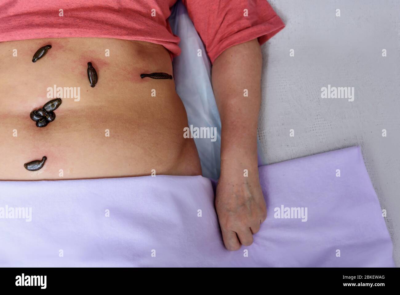 Blutsaugende Leechs hirudo medicinalis auf dem Bauch der Frau in einem rosa T-Shirt. Ansicht von oben Stockfoto