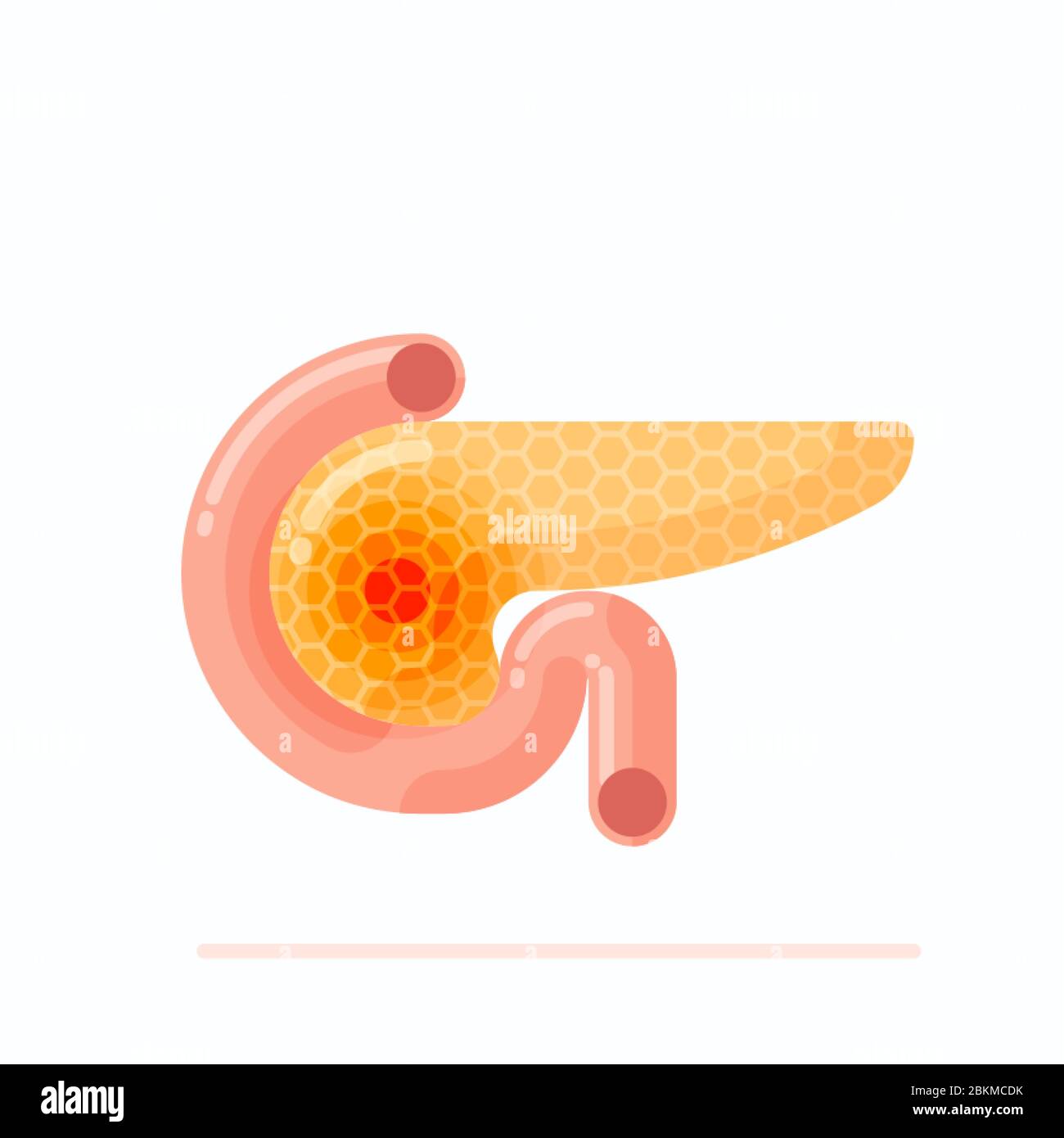 Abbildung zeigt kranke menschliche Bauchspeicheldrüse, Konzept der menschlichen Pankreatitis und Krebs, flaches Design Vektor Illustration Stock Vektor