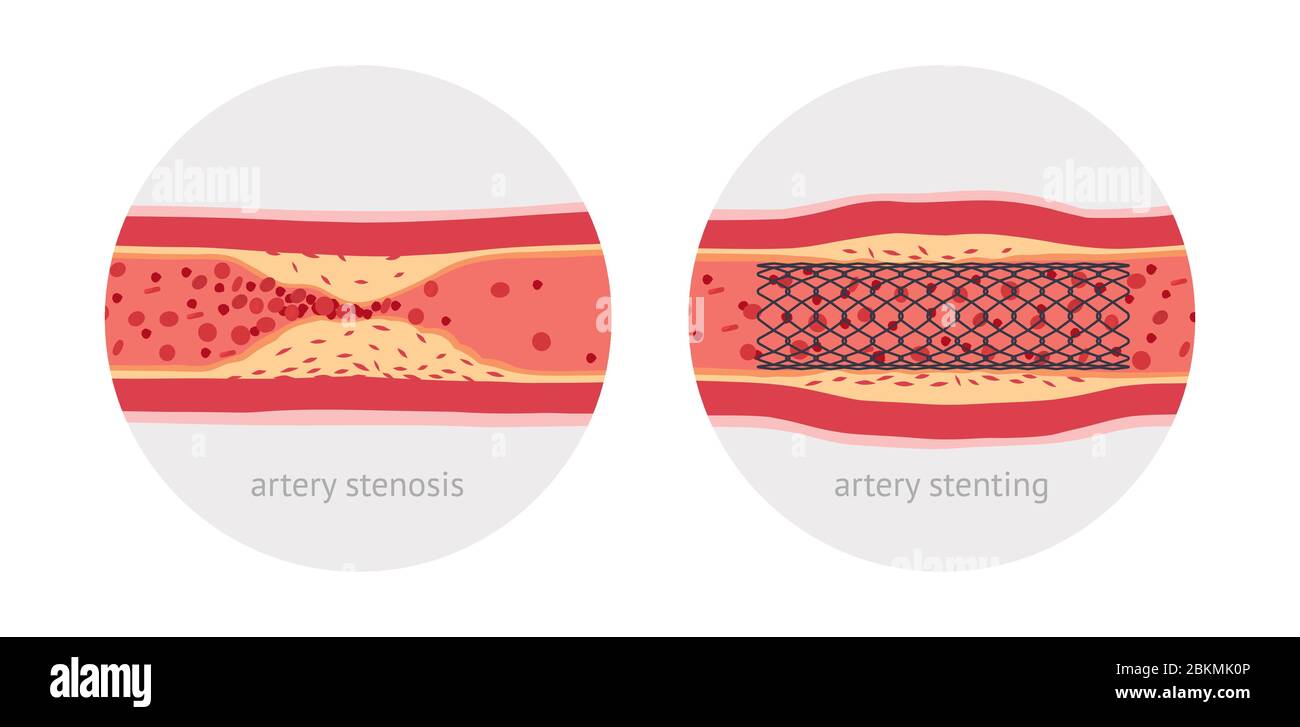 Stentende kranke menschliche Arterie, vor und nach, flache Design-Illustration Stock Vektor