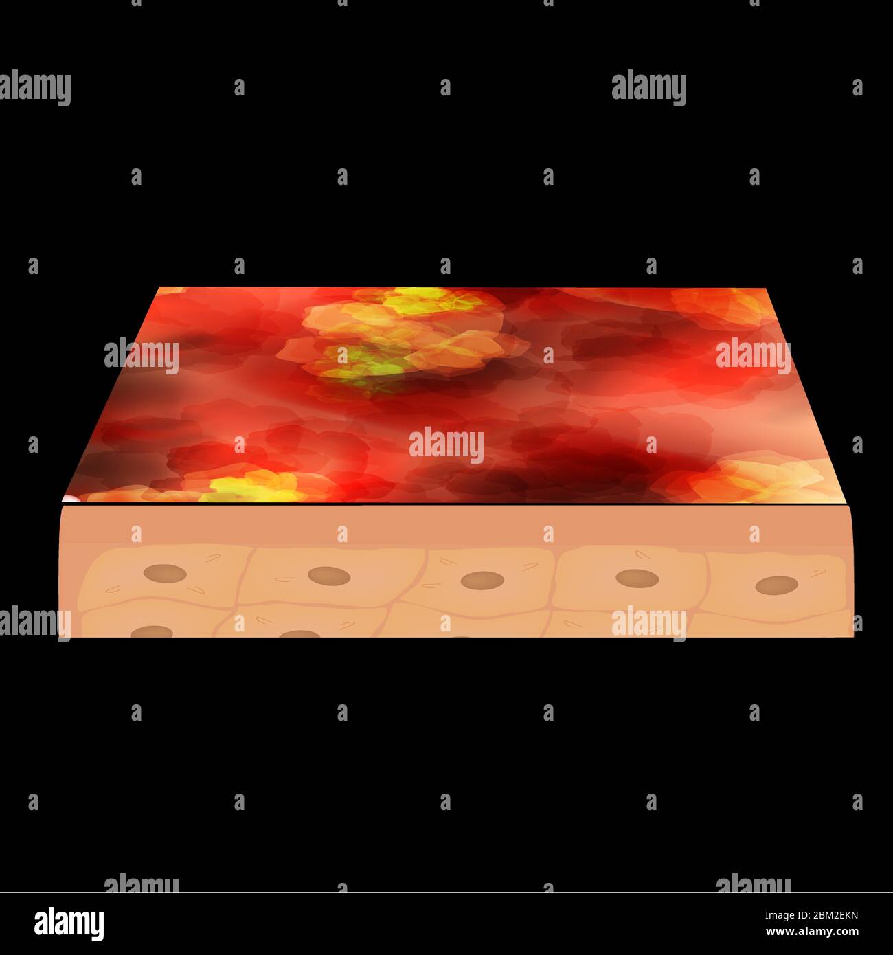 Zyste Akne. furonheim Acne auf der Haut Zysten und Pickel. Dermatologische und kosmetische Entzündungserkrankungen auf der Haut des Gesichts. Infografiken Stock Vektor