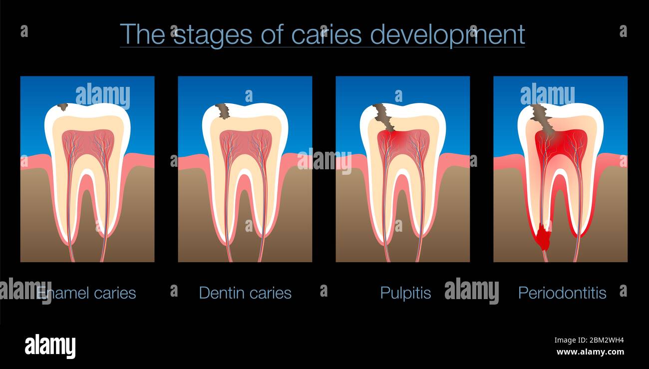 Karies, Kariesentwicklung, Zahnschmelz und Dentin Karies, Pulpitis und Parodontitis - Abbildung auf schwarzem Hintergrund. Stockfoto