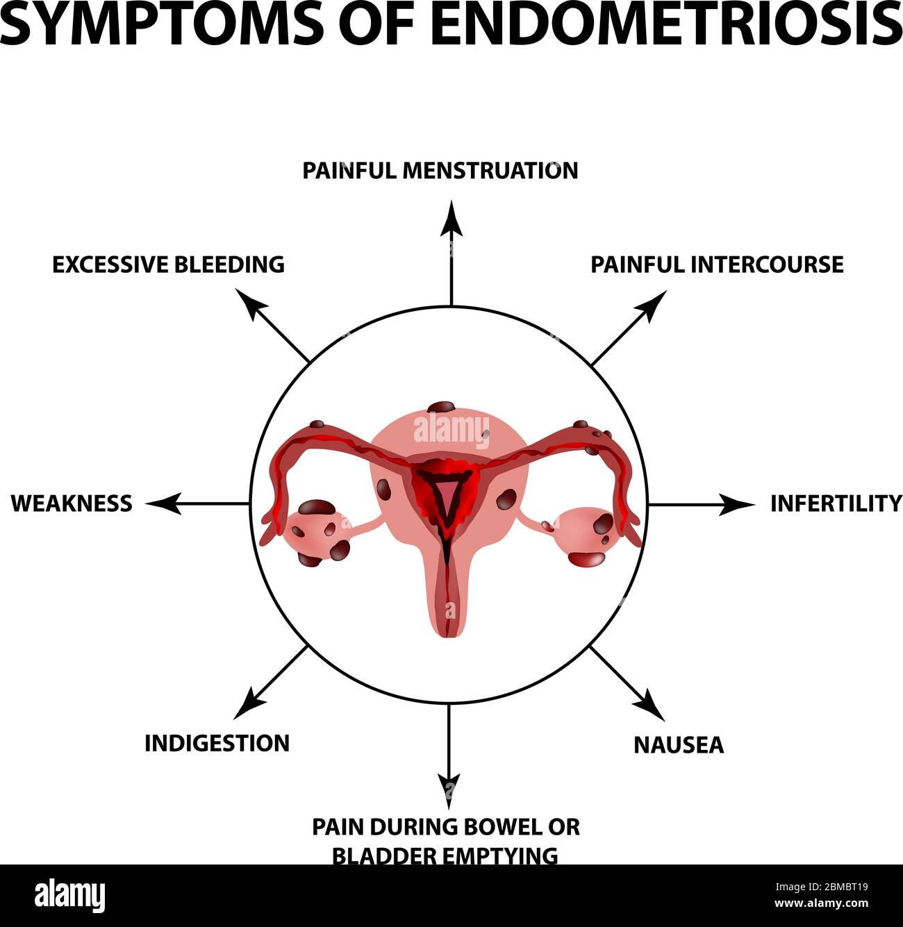 Symptome der Endometriose. Die Struktur der Uterus ovaries
