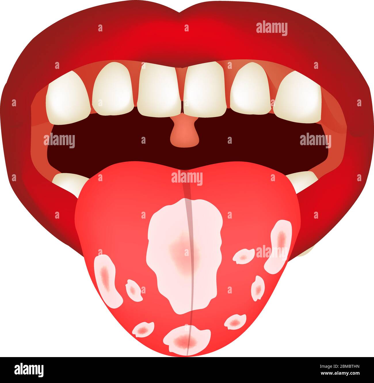 Mundsoor. Candidiasis auf der Zunge. Pilz im Mund. Infografiken. Vektorgrafik auf isoliertem Hintergrund. Stock Vektor