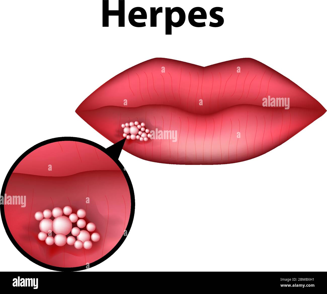 Herpes zoster rash Stock-Vektorgrafiken kaufen - Alamy