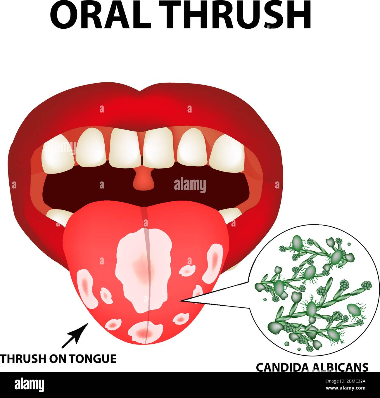 Mundsoor. Candidiasis auf der Zunge. Pilz im Mund. Infografiken. Vektorgrafik auf isoliertem Hintergrund. Stock Vektor