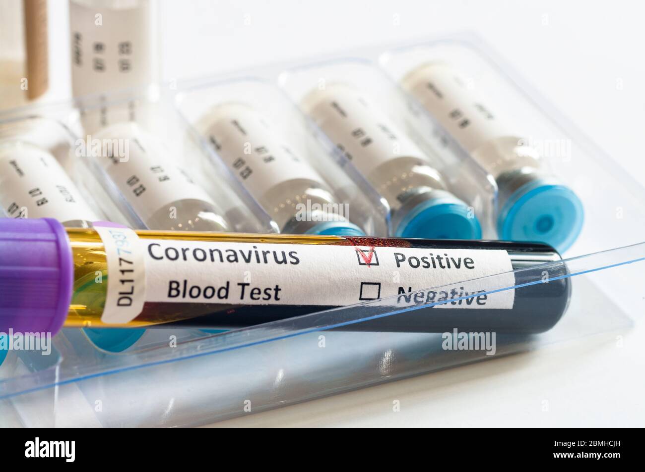 Blutprobenschlauch positiv mit COVID-19 oder neuartigem Coronavirus SARS-CoV-2. Stockfoto