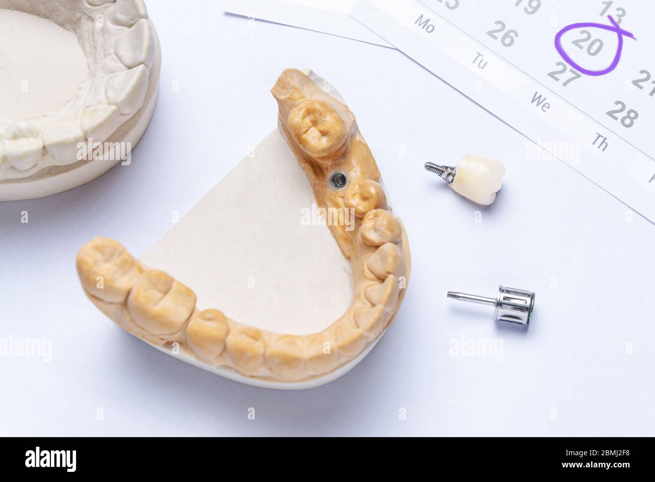 Ein Zahnimplantat mit einer Keramikkrone und einem Zahninstrument liegt auf einem weißen Hintergrund, im Kalender oben rechts, der einen Besuch beim Zahnarzt anzeigt Stockfoto