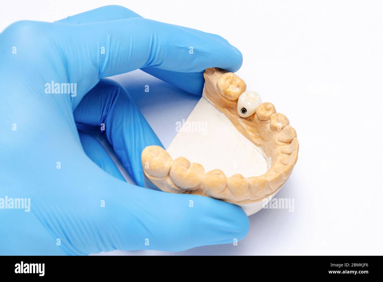 Eine Hand hält ein Gipsmodell des Unterkiefers mit einer Keramikkrone auf einem Zahnimplantat. Konzept der Prothetik auf Zahnimplantaten. Zahnimplantate Stockfoto