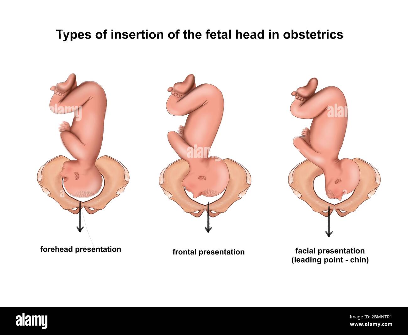 Abbildung des Einführens des Fetalkopfes bei obsterischen Darstellungen Stockfoto