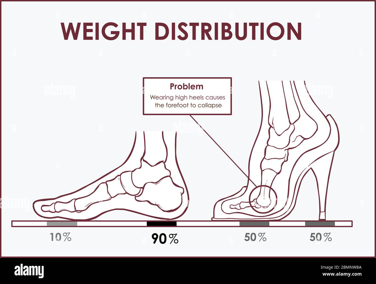 Vektordarstellung von Fußschmerzen und Gewichtsverteilung durch das Tragen von High Heels Stock Vektor