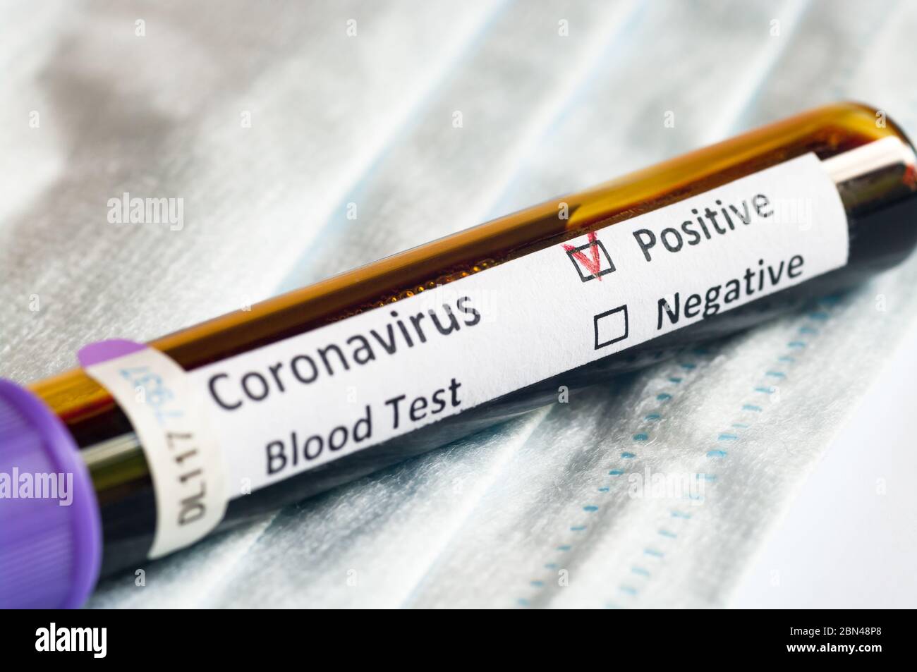 Blutprobenschlauch positiv mit COVID-19 oder neuartigem Coronavirus SARS-CoV-2. Stockfoto