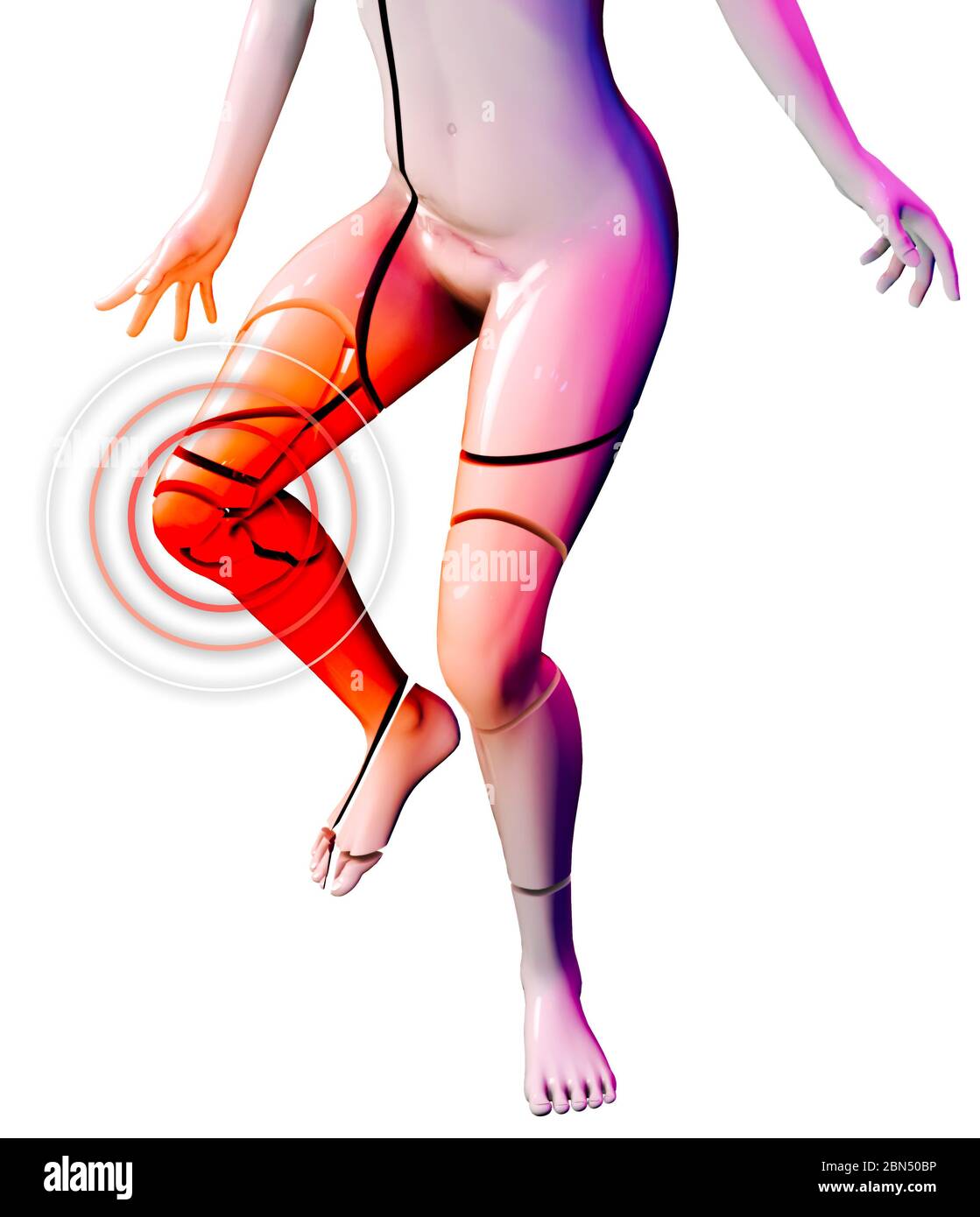 Osteogenesis imperfecta, spröde Knochenerkrankung, genetische Störungen. Es führt zu Knochen, die leicht brechen. Patella-Fraktur. Kreuzband Stockfoto