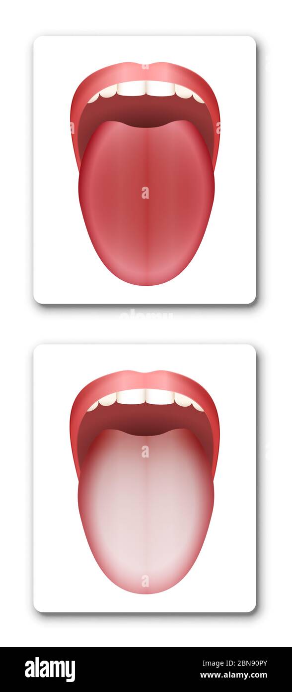 Saubere gesunde Zunge und beschichtete weiße Zunge im Vergleich - Abbildung auf weißem Hintergrund. Stockfoto