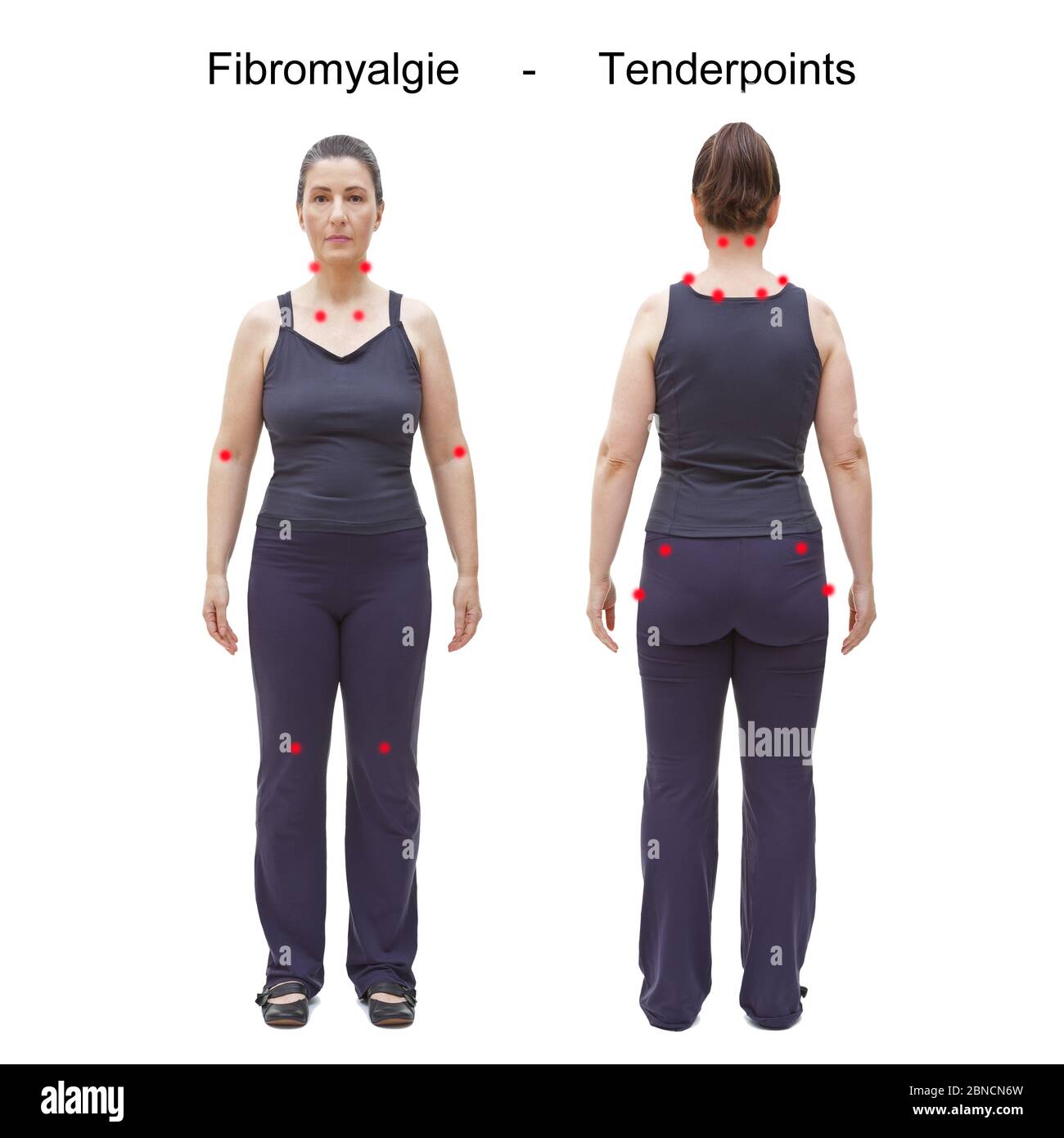 Die 18 Tender- oder Triggerpunkte von fibromyalgie / Fibromyalgie, gekennzeichnet durch rote Flecken am Körper einer Frau, deutscher Text. Stockfoto