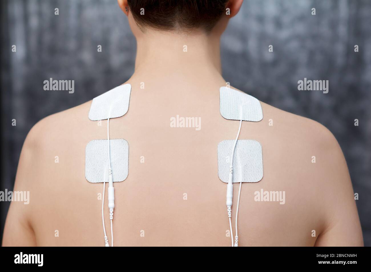 TENS-Therapie bei Fibromyalgie-Behandlung - Elektroden auf den Schultern der weiblichen Patientin. Stockfoto