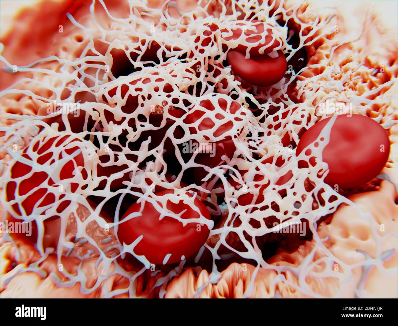 Blutgerinnsel, Illustration. Rote Blutkörperchen (Erythrozyten) sind in einem Fibrin-Protein-Netz (weiß) gefangen. Das Fibrin-Netz wird als Reaktion auf Chemikalien gebildet, die von Thrombozyten, Fragmenten weißer Blutkörperchen, sezerniert werden. Gerinnsel werden als Reaktion auf Herz-Kreislauf-Erkrankungen oder Verletzungen der Blutgefäße gebildet. Stockfoto