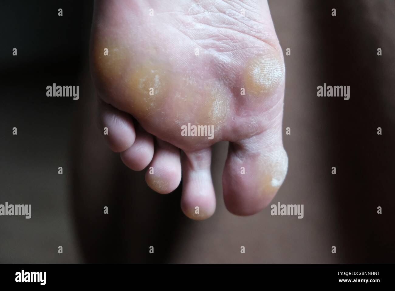 Fußpilz, Tinea pedis, Pilz infection.dermatology Krankheit. Beinpilz vor der Behandlung. Pilznägel unansehnlich, verdickt und krümelig, werden Pai Stockfoto