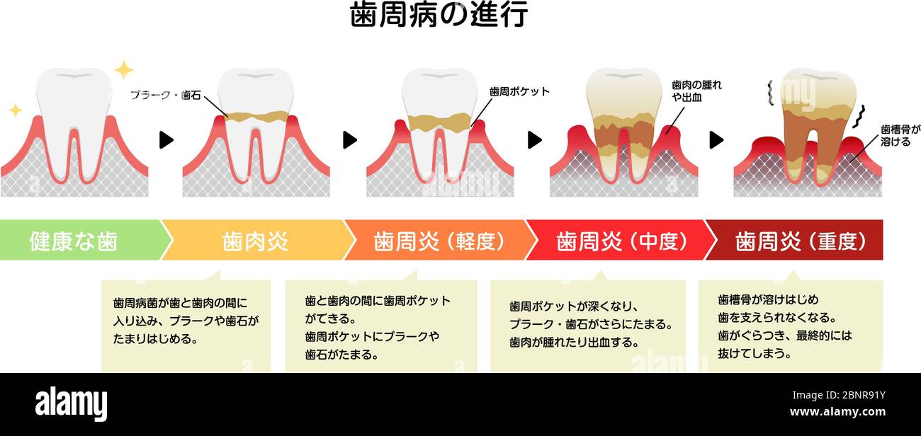Die Stadien der Parodontitis Krankheit Vektor Illustration Stock Vektor