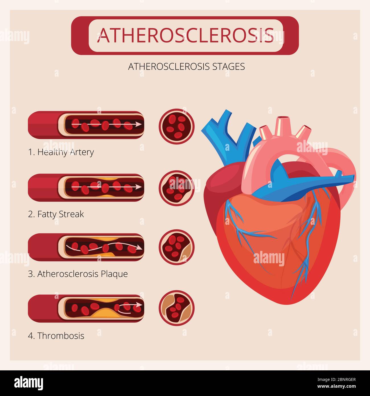 Atherosklerose Stadien. Herzschläge Thrombus Angriff Blut Kreislauf-System Vektor medizinische Infografiken Stock Vektor