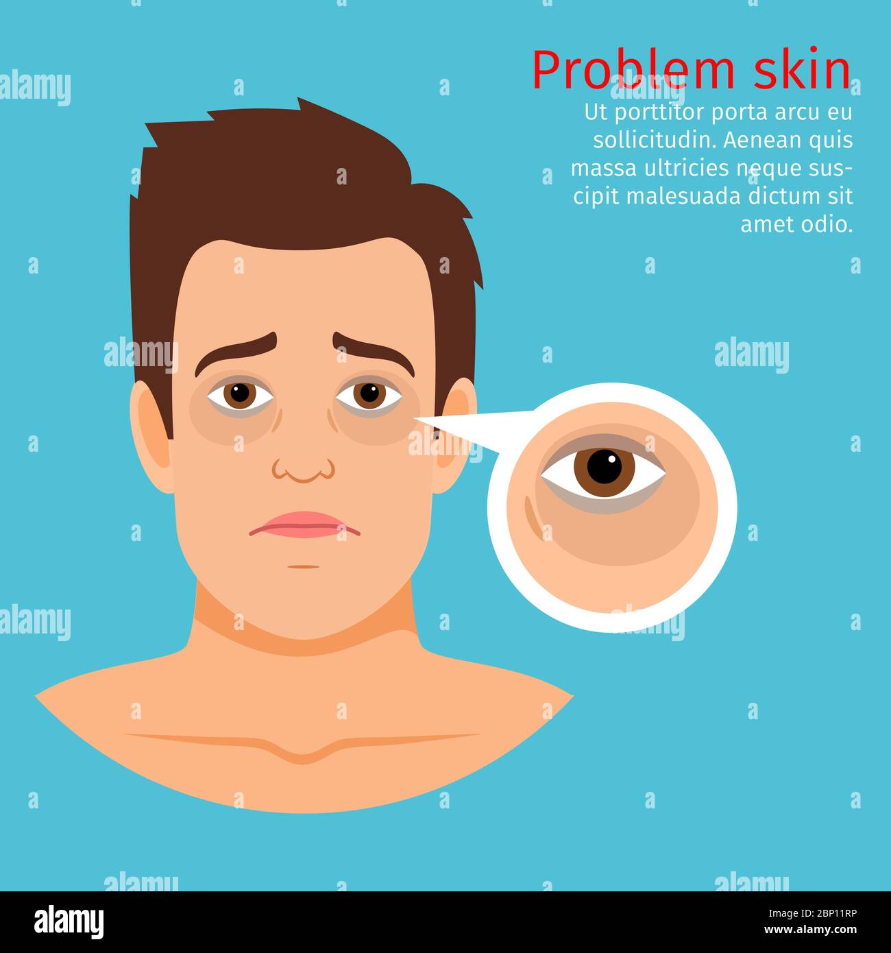 Junger Mann Gesicht Problem Haut mit schwarzen Kreisen unter den Augen, Vektor-Illustration Stock Vektor