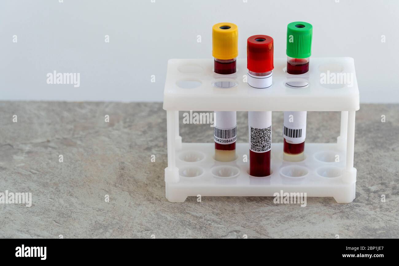 Test auf Coronavirus. Medizinische Flasche mit einem Bluttest auf das Virus COVID-19 Stockfoto