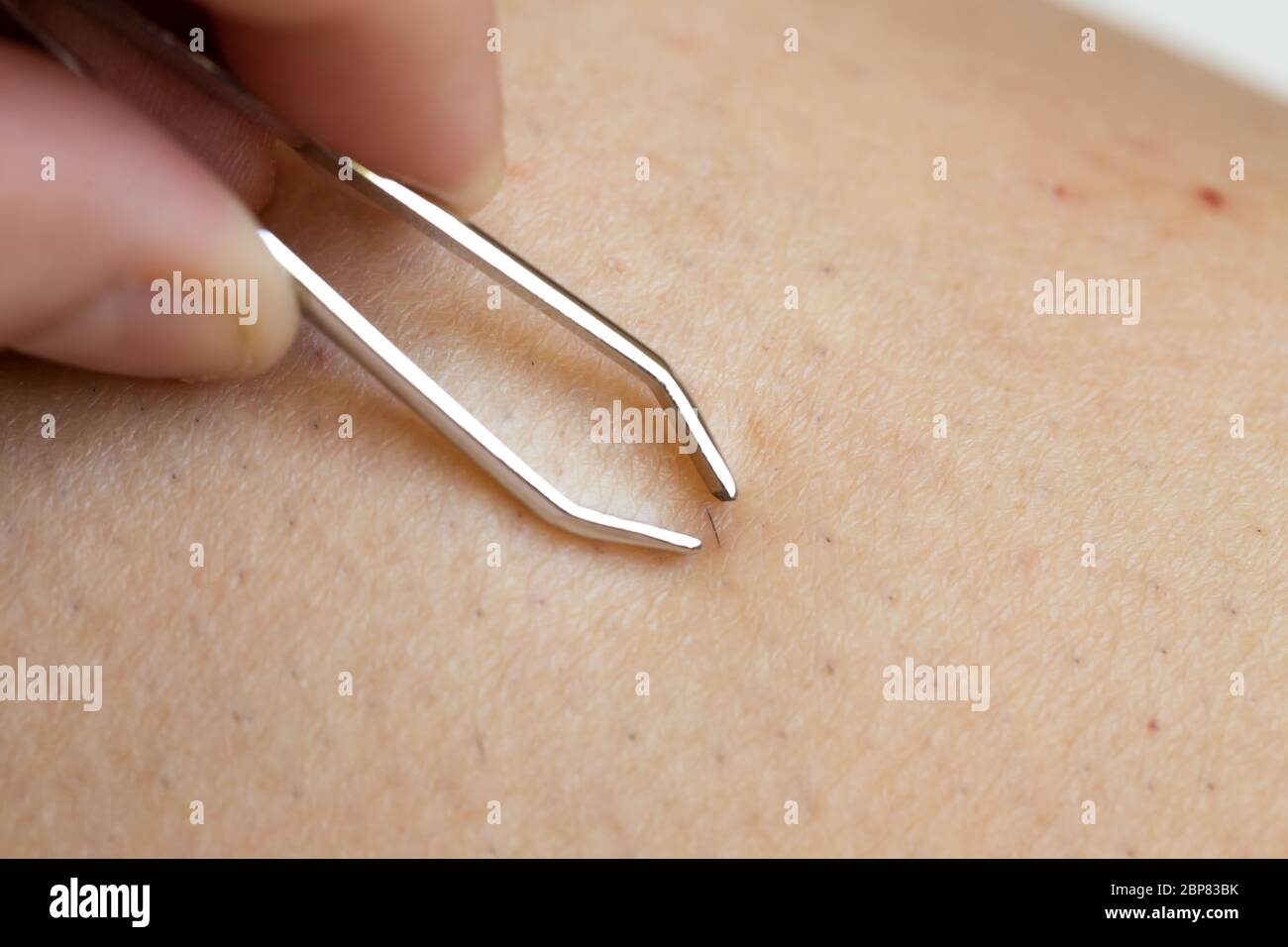 Entfernen eingewachsene Haare mit Pinzette nach dem Rasieren Beine  Stockfotografie - Alamy
