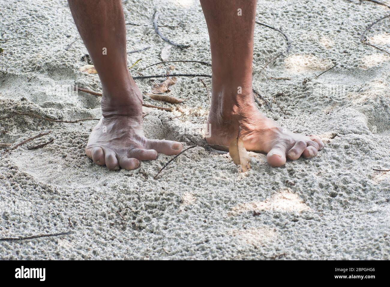 Eine Fußdeformität ist eine Störung des Fußes, die angeboren oder erworben werden kann. Stockfoto