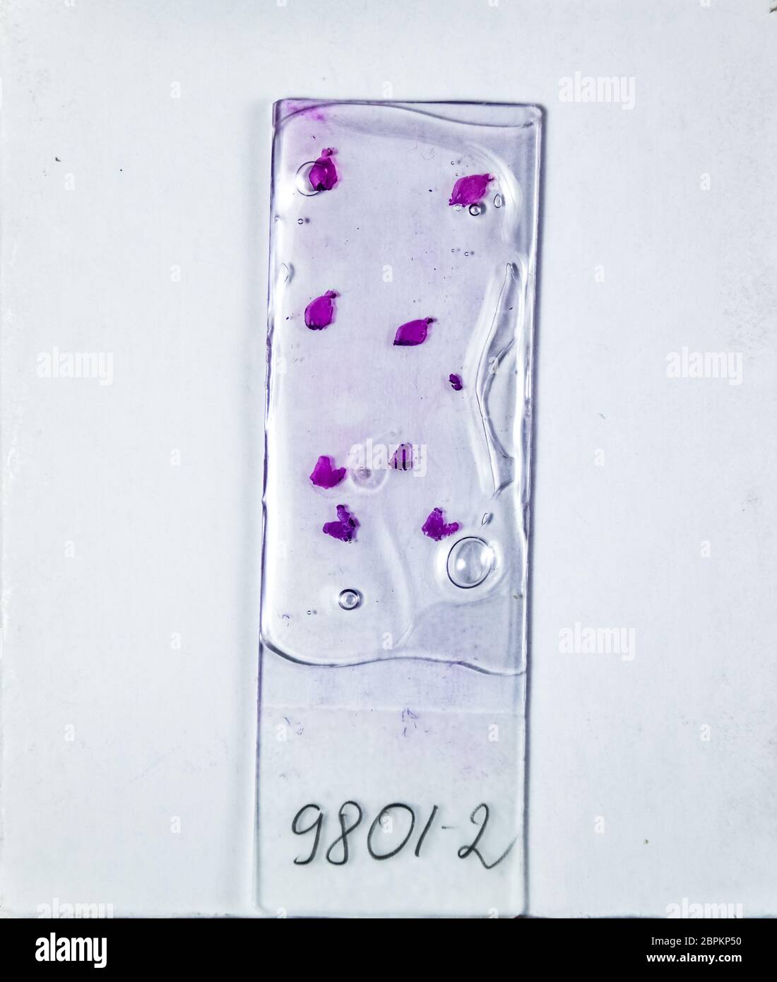 Schichten des Tumors unter Glas. Die histologische Untersuchung der ...