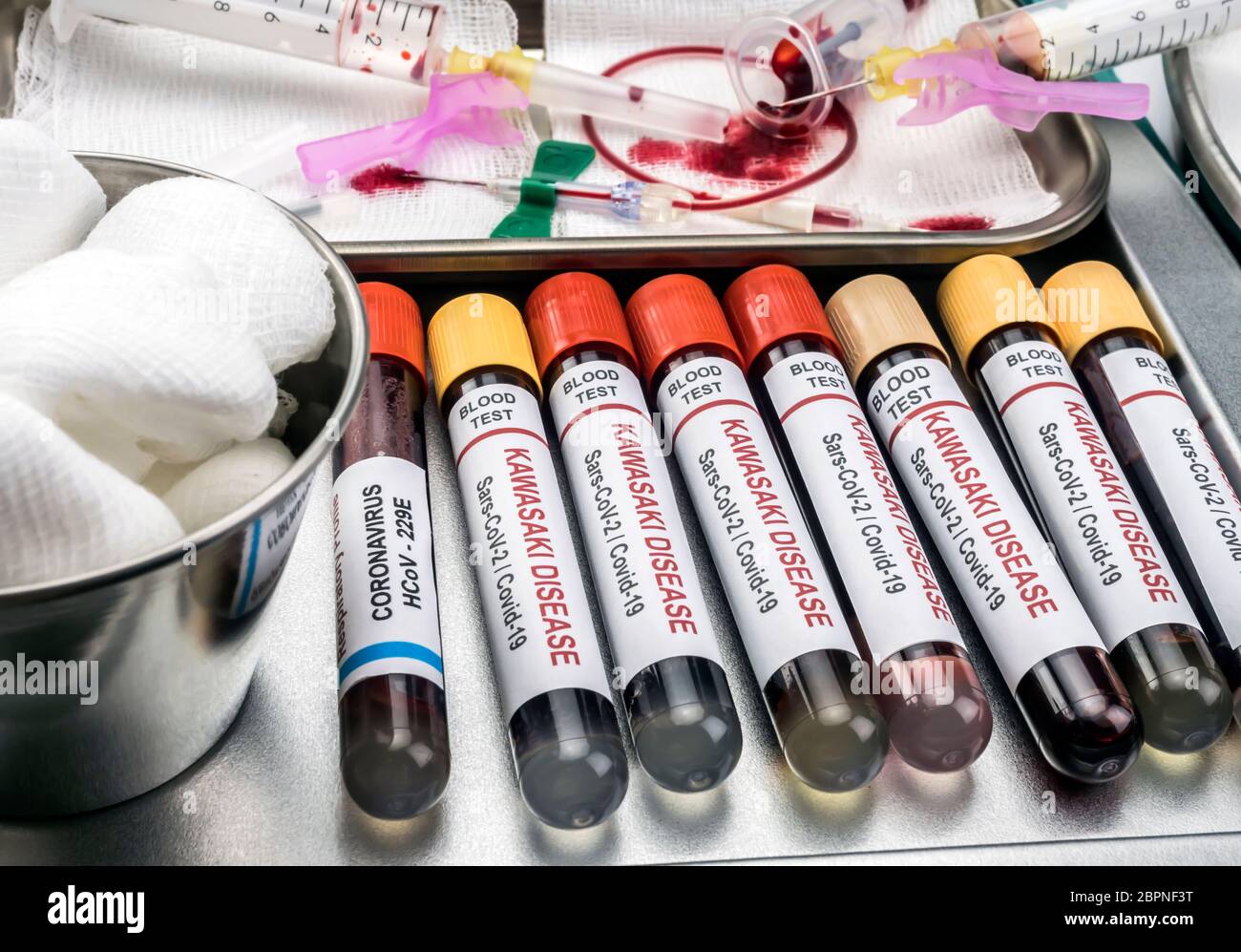 Blutproben zur Behandlung der mit SARS-CoV-2 zusammenhängenden Kawasaki-Krankheit bei Kindern unter fünf Jahren, konzeptionelles Bild Stockfoto