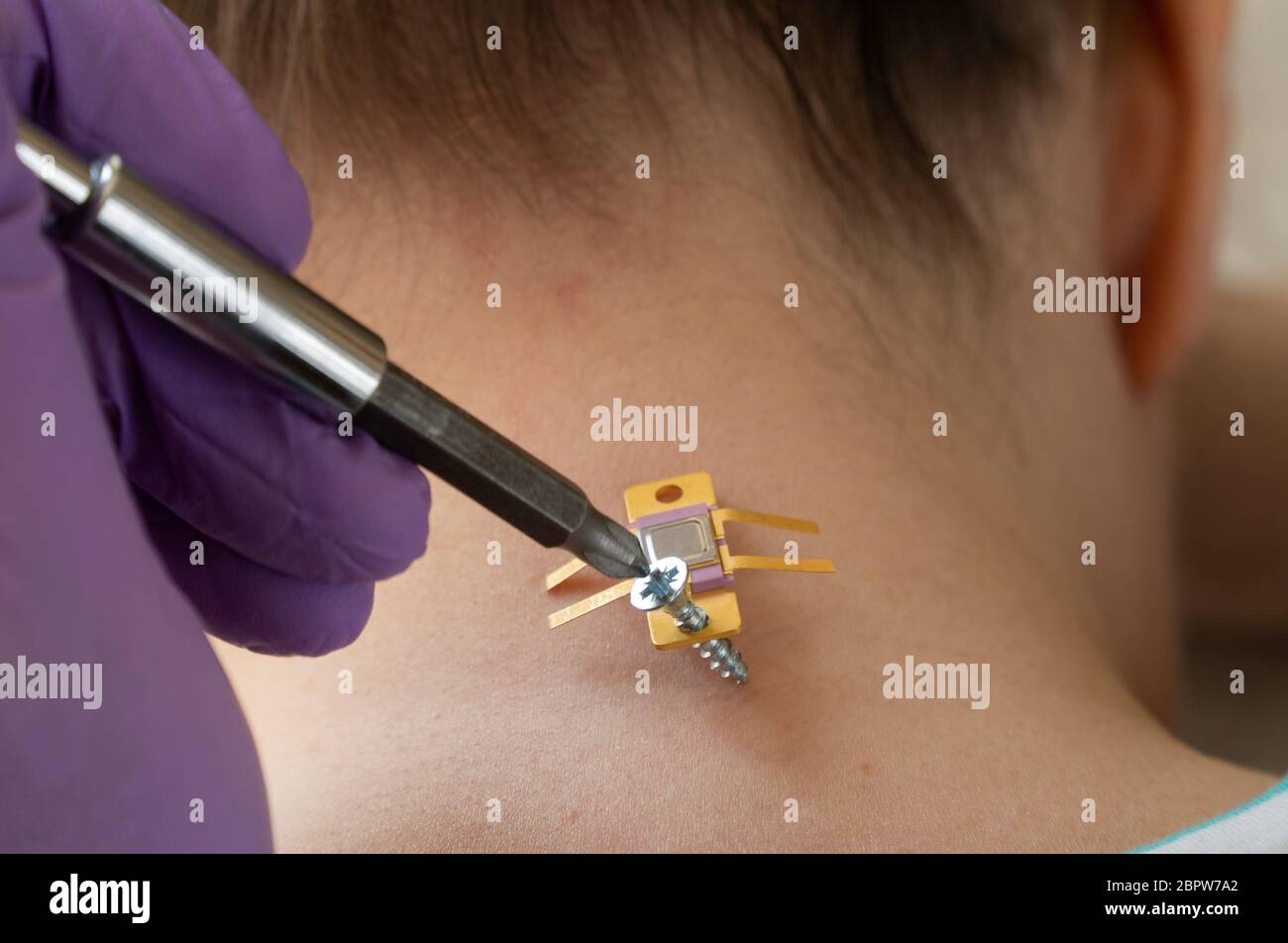 Implantation des Chips unter der menschlichen Haut. microchip ist mit
