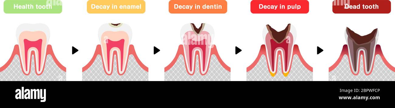 Die Stadien der Karies / flache Vektor-Illustration Stock Vektor