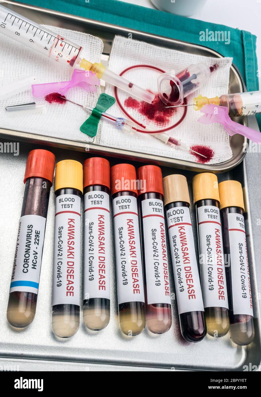 Blutproben zur Behandlung der mit SARS-CoV-2 zusammenhängenden Kawasaki-Krankheit bei Kindern unter fünf Jahren, konzeptionelles Bild Stockfoto