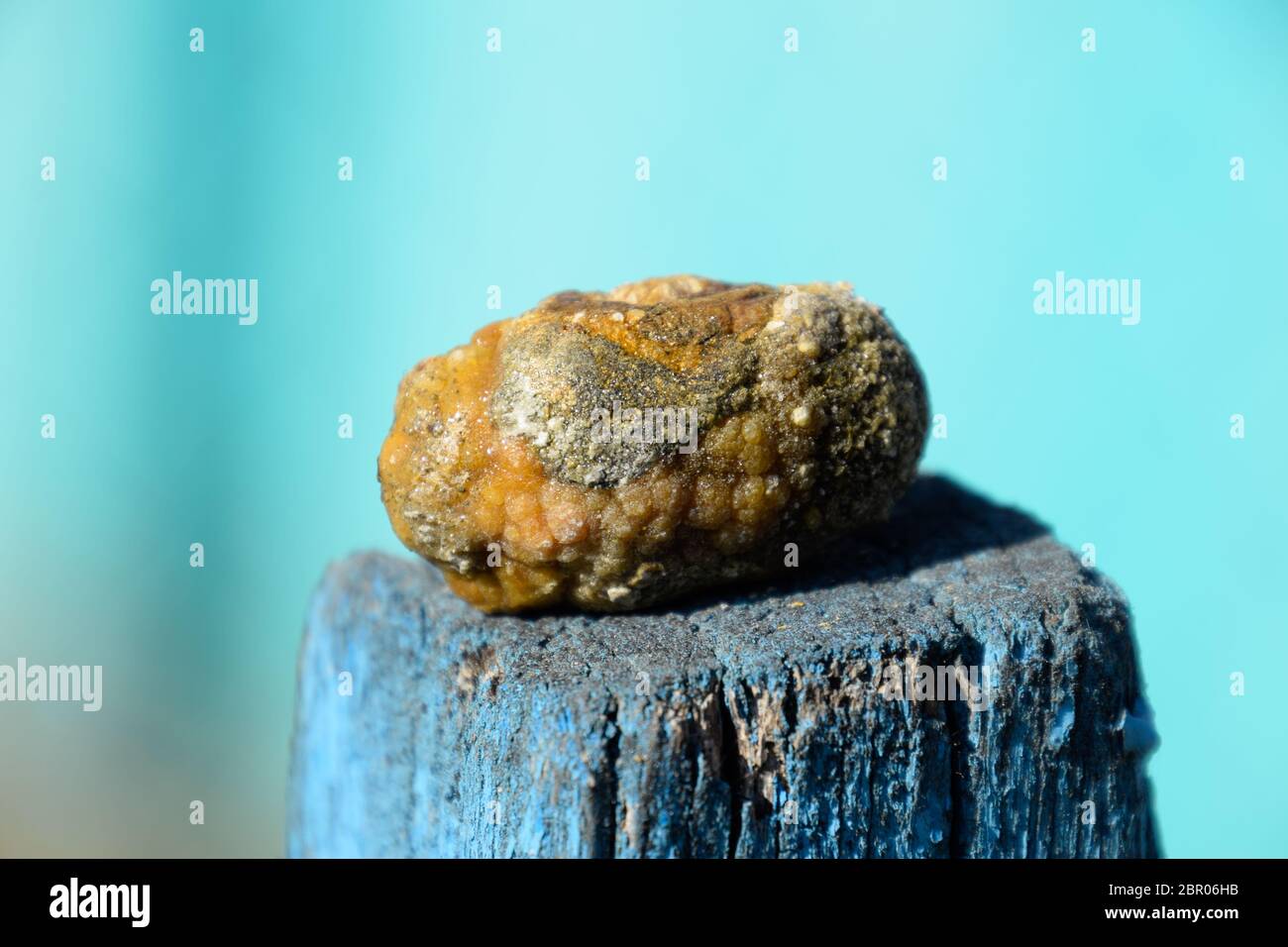 Gallenblase Stein. Das Ergebnis von Gallensteinen. Kalkül der heterogenen Zusammensetzung Stockfoto