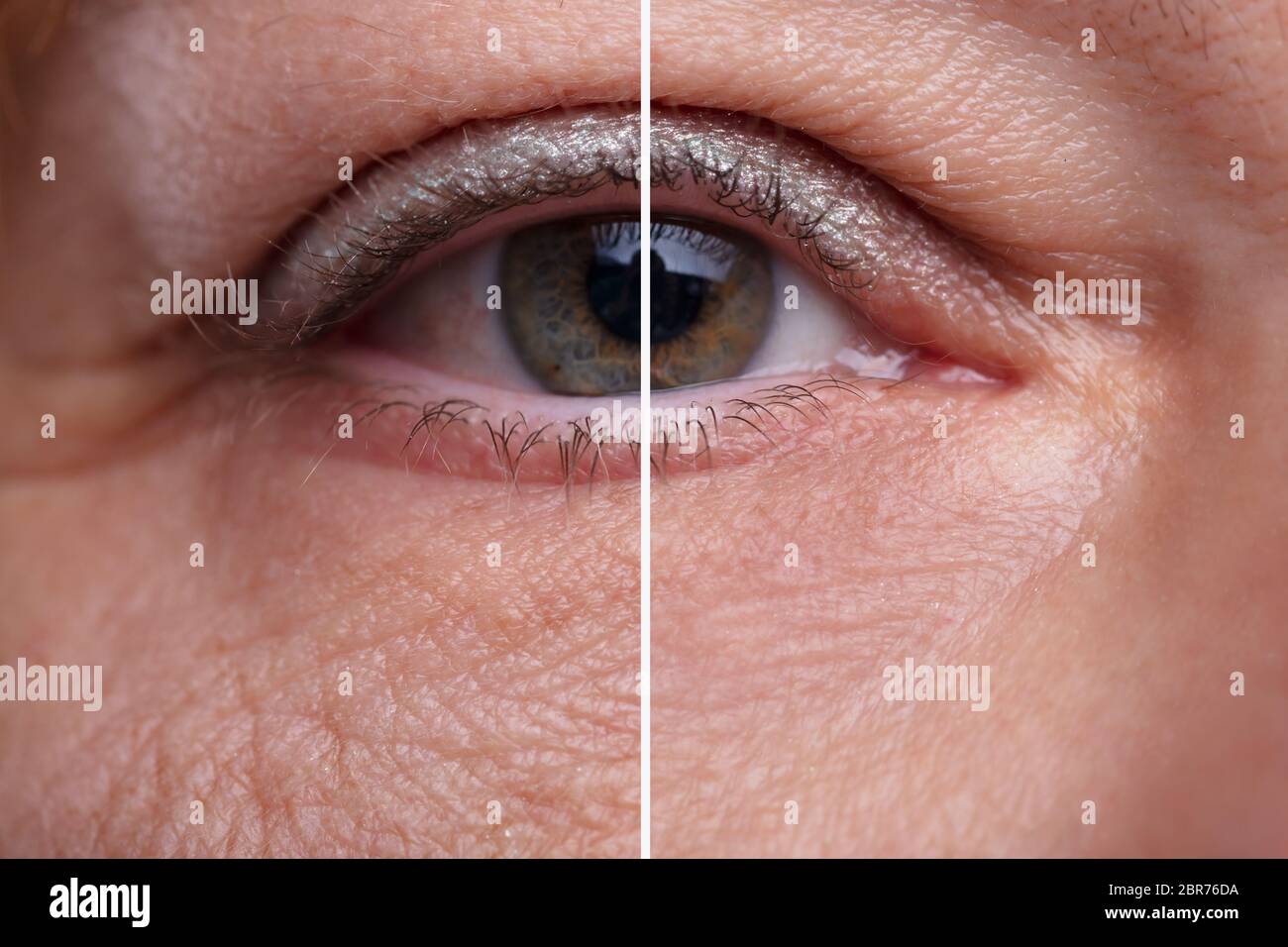 Close-up Woman's Eye Beutel Vor und Nach der kosmetischen Behandlung Stockfoto