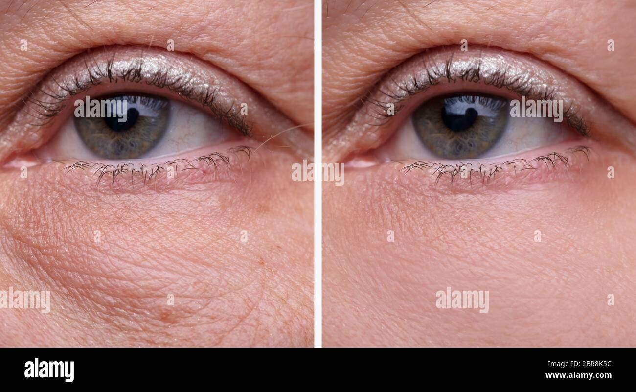 Close-up Woman's Eye Beutel Vor und Nach der kosmetischen Behandlung Stockfoto