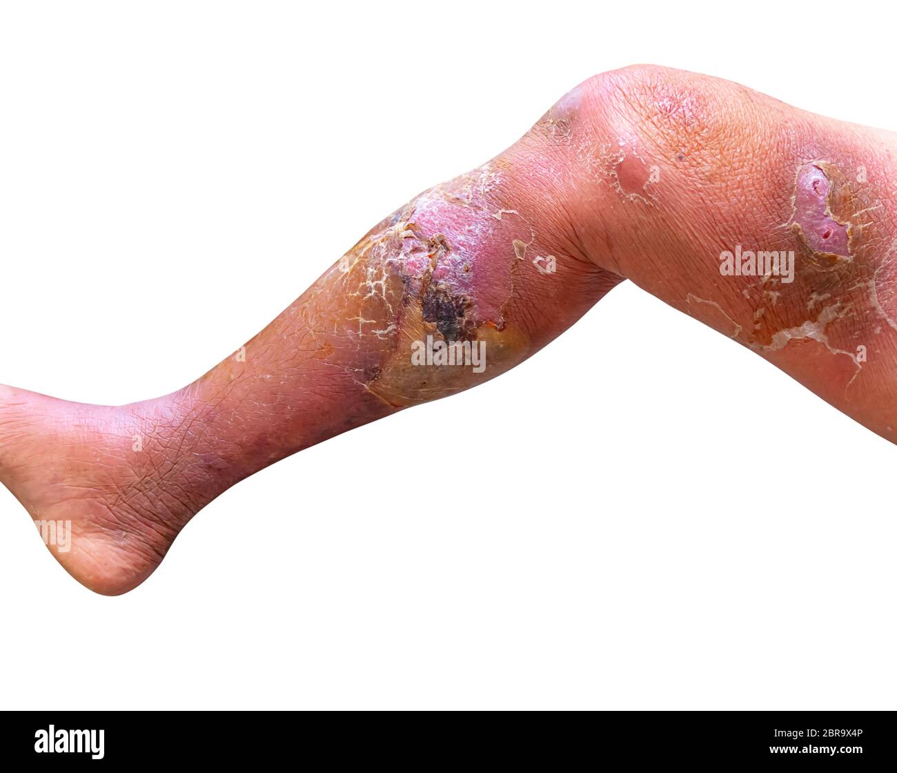 Erysipeln bakterielle Infektion unter der Haut Bein gealterten Menschen auf weißem Hintergrund Stockfoto