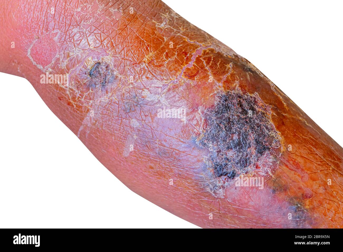 Erysipeln bakterielle Infektion unter der Haut Bein gealterten Menschen auf weißem Hintergrund Stockfoto