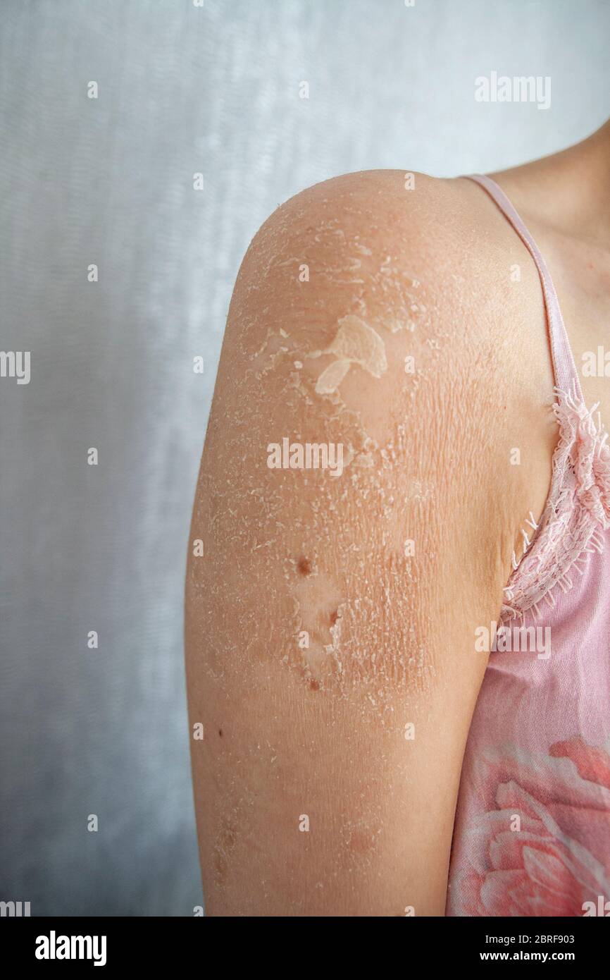 Nahaufnahme von Ekzem (Dermatitis), Allergie, Psoriasis, Fungal, trockene oder verbrannte Haut. Nahaufnahme der Frau Schulter. Konzept der Gesundheitsfürsorge. Stockfoto