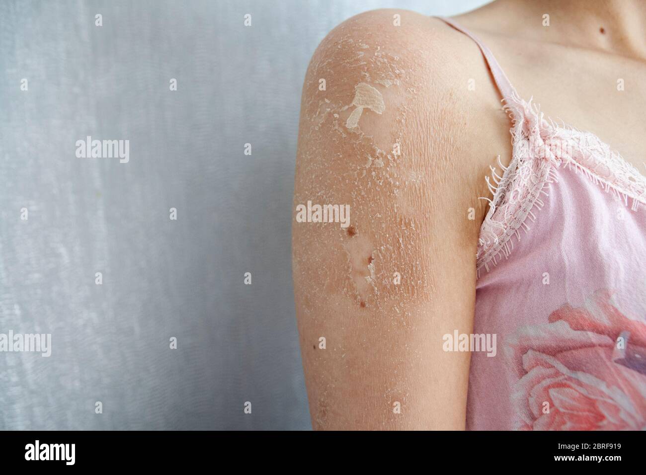 Nahaufnahme von Ekzem (Dermatitis), Allergie, Psoriasis, Fungal, trockene oder verbrannte Haut. Nahaufnahme der Frau Schulter. Konzept der Gesundheitsfürsorge. Stockfoto