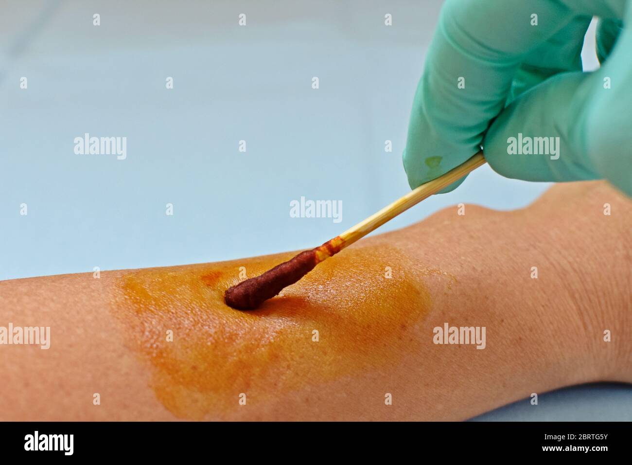 Arzt Hand Anwendung Jod auf eine weiße Armnarbe. Medizinisches Konzept. Stockfoto