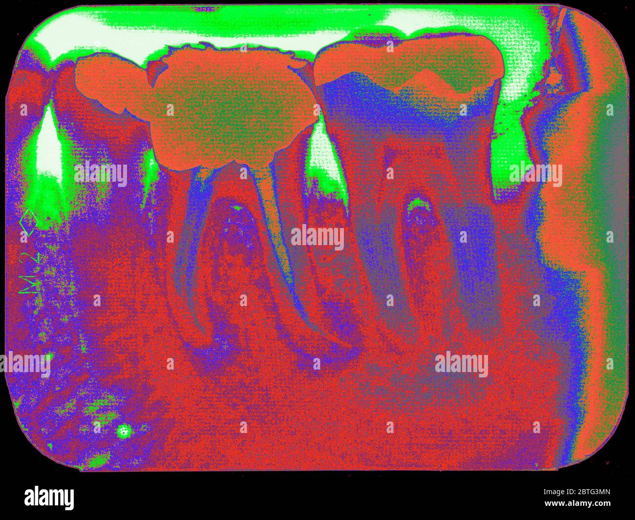 Zahn-Röntgenaufnahme, nach Wurzelkanalbehandlung Stockfoto