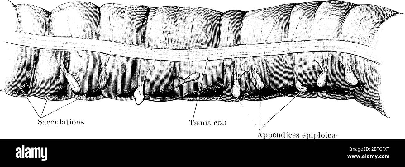 Ein Stück transversalen Dickdarm von einem zwei Jahre alten, Kind. Es zeigt, sacculatiousm, taeniaem und Anhänge epiploicae, die drei wichtigsten Merkmale Stock Vektor