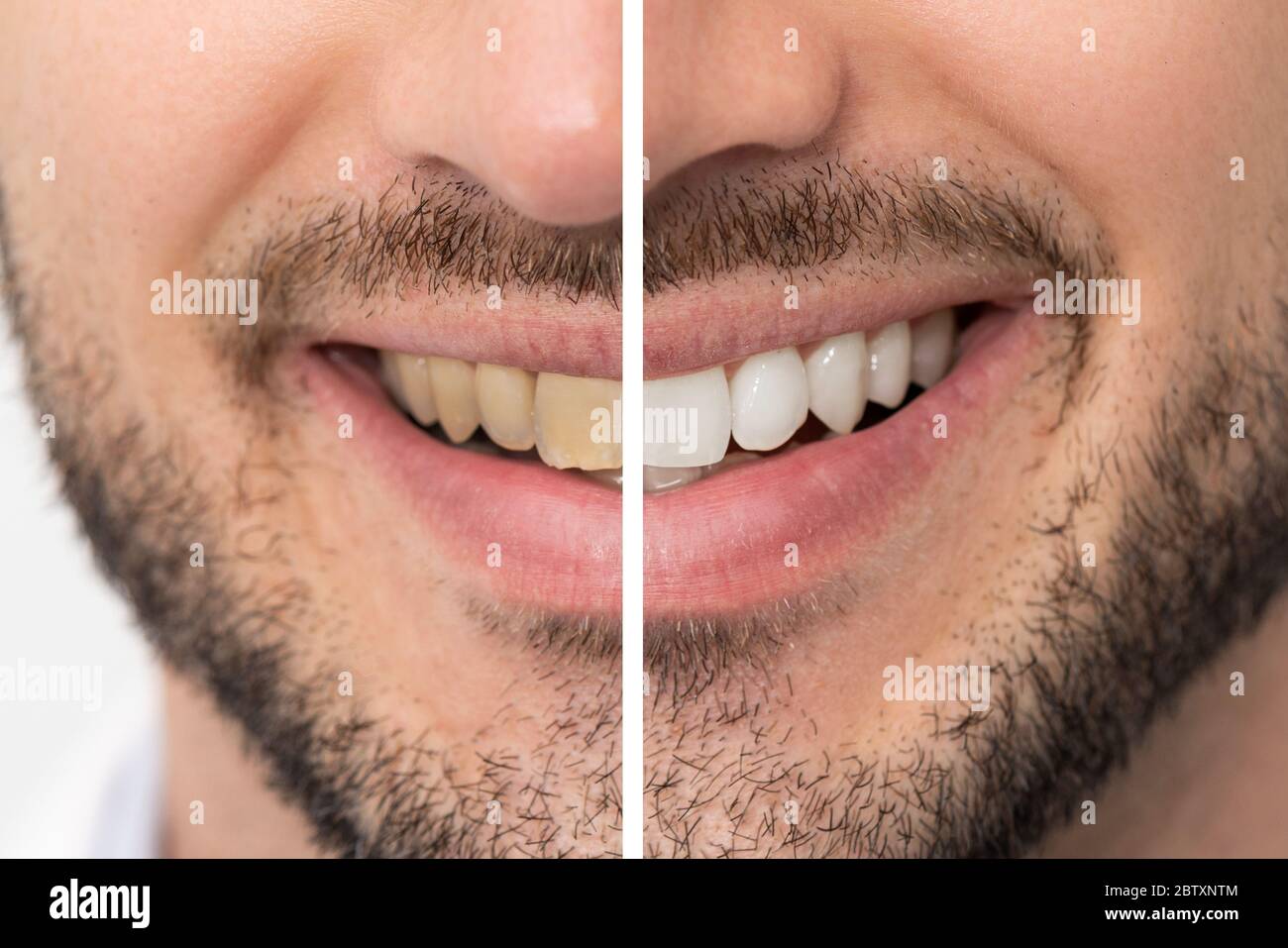 Zähne vor und nach dem Aufhellen. Zahnärztliche Versorgung Konzept Stockfoto