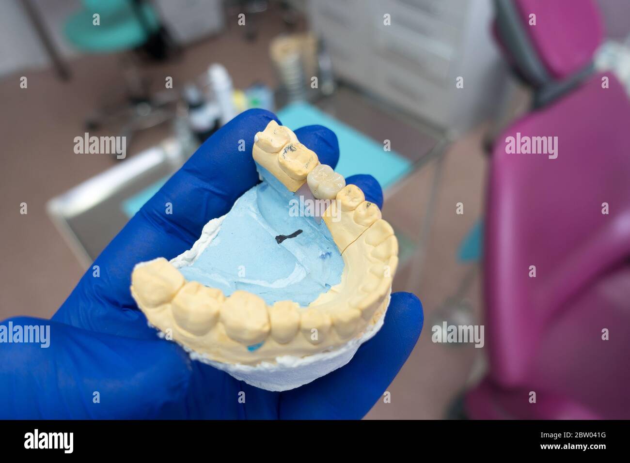Close-up Keramik Zahn Krone auf einem gipsmodell der Zähne in die Hand des Zahnarztes. Arbeit der Zahntechniker Stockfoto