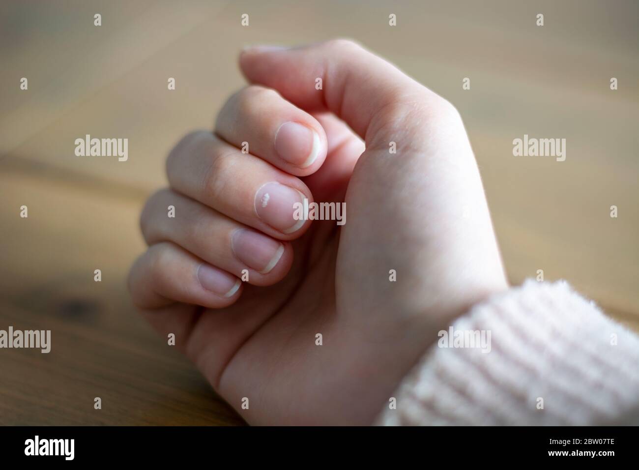 Weißer Fleck auf dem Fingernagel der Frau, Leukonychie genannt. Es gibt verschiedene Formen von Leukonychien. Manchmal ist die Ursache unklar Stockfoto