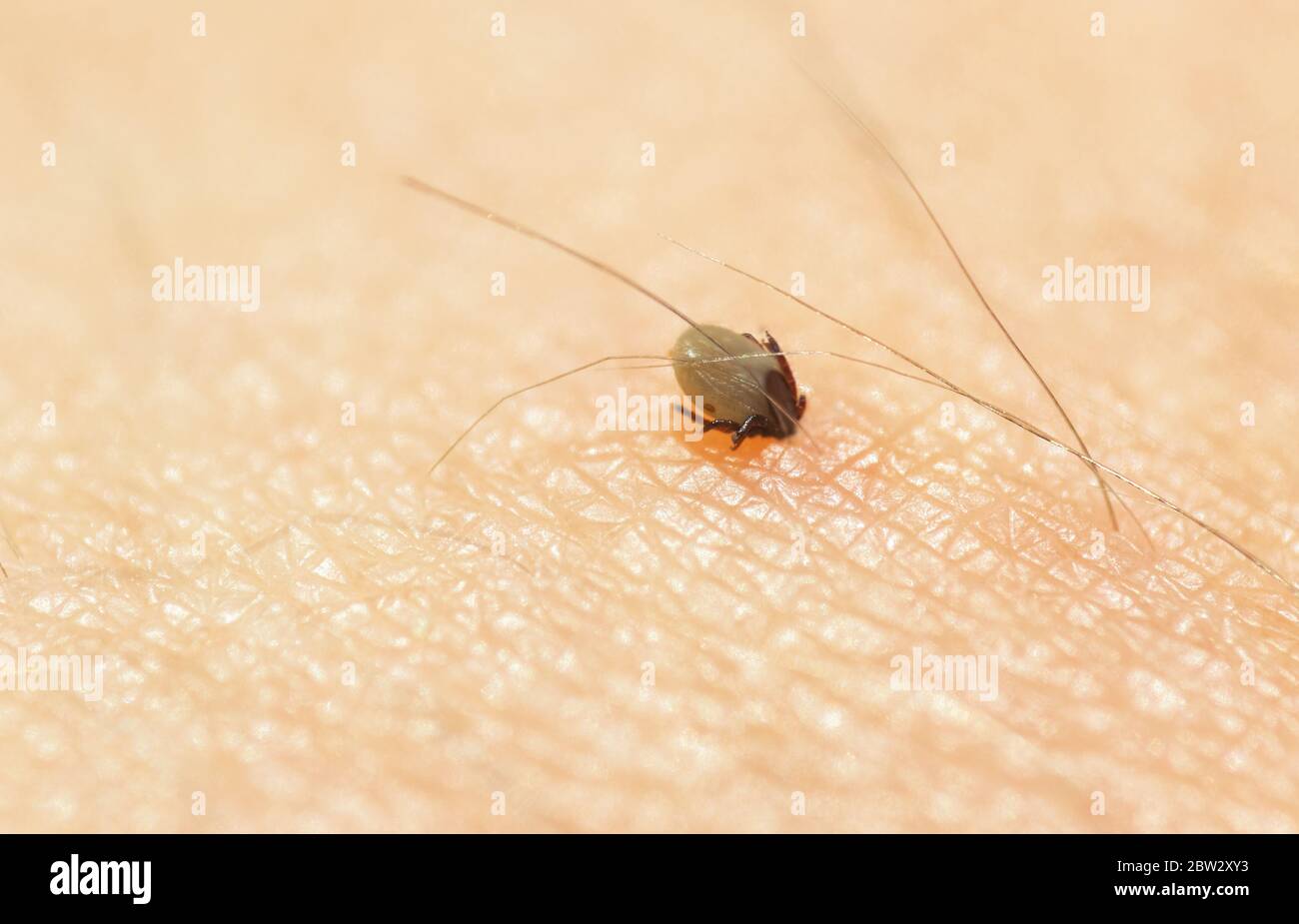 Kleine Ixodes ricinus-Käfer auf der menschlichen Haut, die Blut saugt. Zeckeninsekt Parasit beißen, Makro-Foto Stockfoto