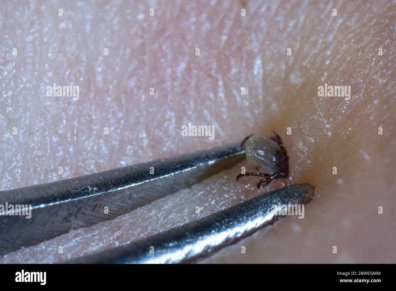 Super close up von saugenden Zecke (Ixodes ricinus) Entfernung mit Stahlpinzette auf der menschlichen Haut. Erwachsene Zecken ernähren sich 6–13 Tage lang von großen Säugetieren Stockfoto