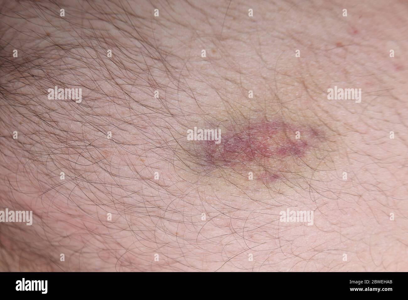 Blutergüsse auf der Haut Stockfoto